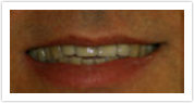 laurel md dental bridges