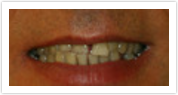 dental bridges laurel md