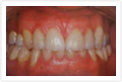 laurel md porcelain crowns