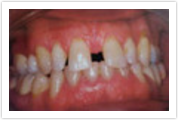 porcelain crowns laurel md