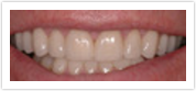 laurel dental crowns