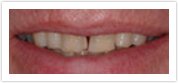 dental crowns laurel md