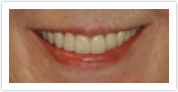 laurel md dental veneers