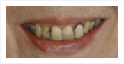 dental veneers laurel md