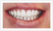 whitening veneers laurel md