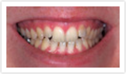 veneers whitening laurel md
