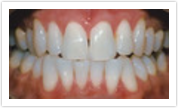 laurel md dental veneers