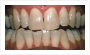 teeth whitening laurel md
